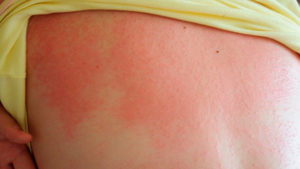 Аллергия на солнце как проявляется